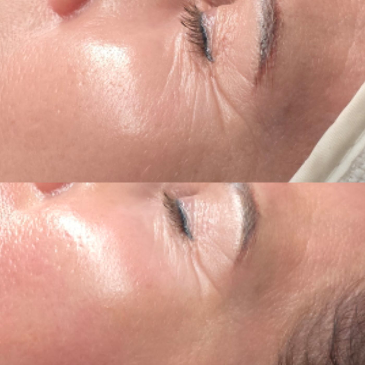 Before and after one Axion microneedling session: smoother fine lines around the eyes