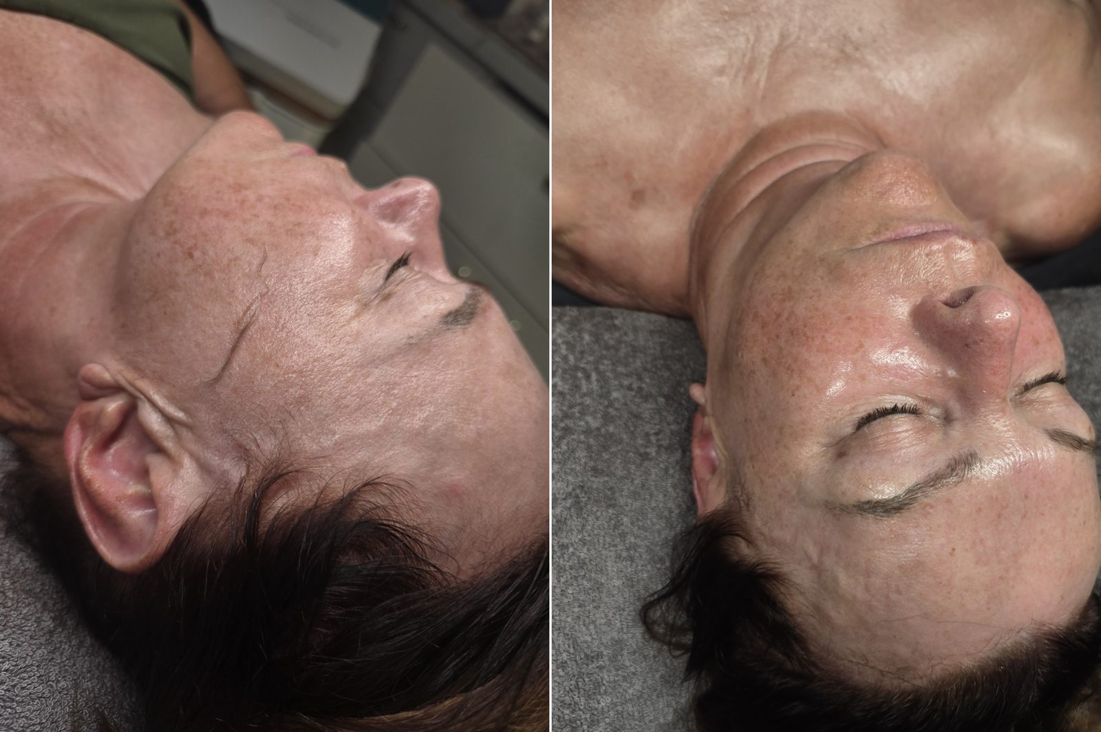Before, during dermaplaning, and after one Circadia Firming Peptide and LED facial