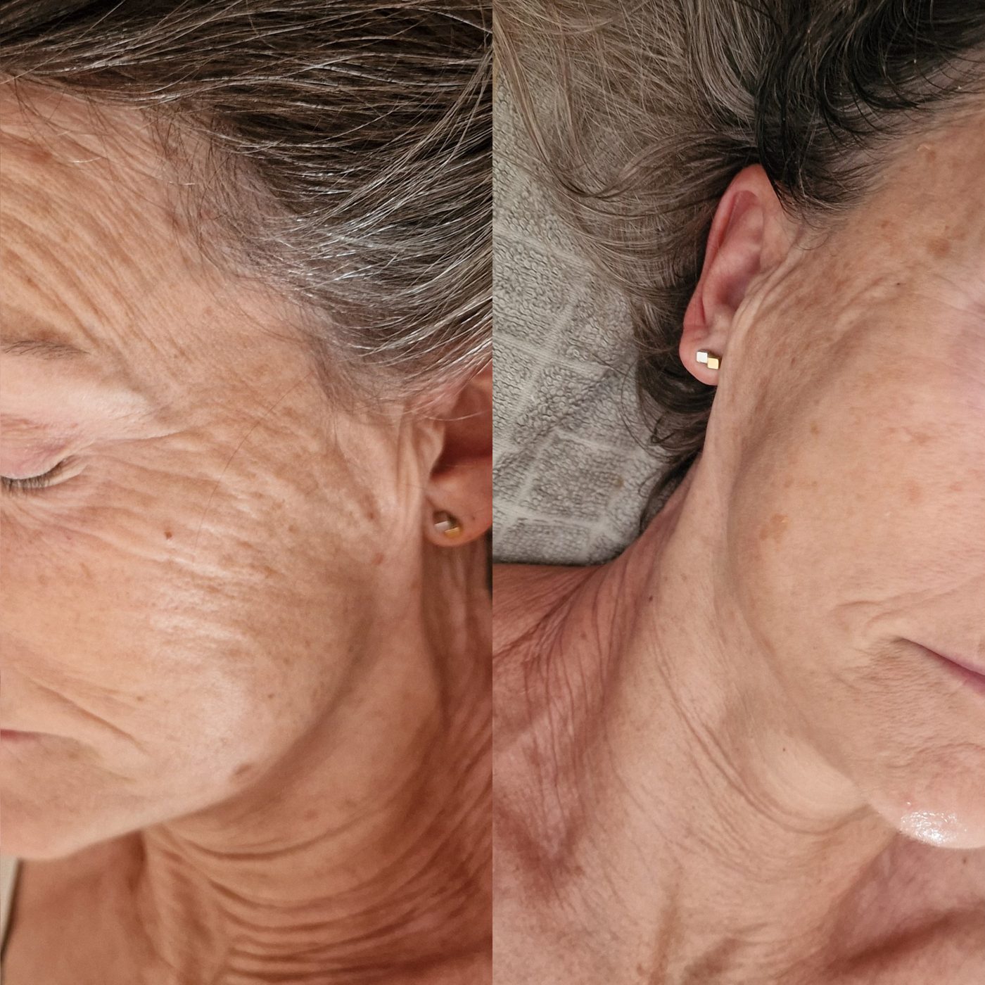 Before and after one radio frequency session with Casmara mask: smoother cheek and neck