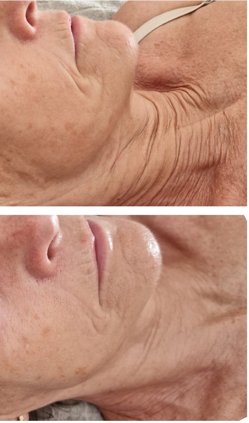 Before and after one radio frequency session with Casmara mask: smoother jawline and neck