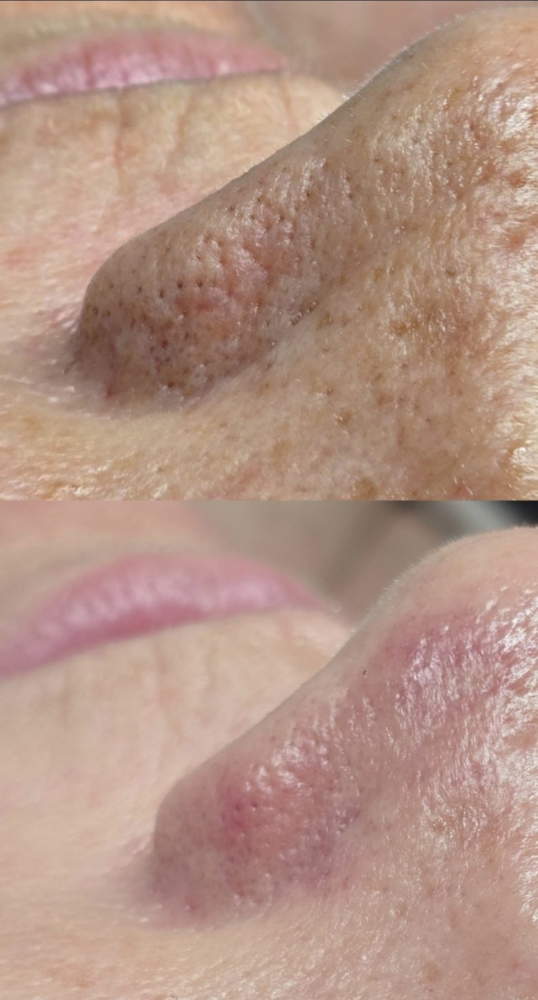 Before and after one HydroDiamond facial: clearer pores on the nose