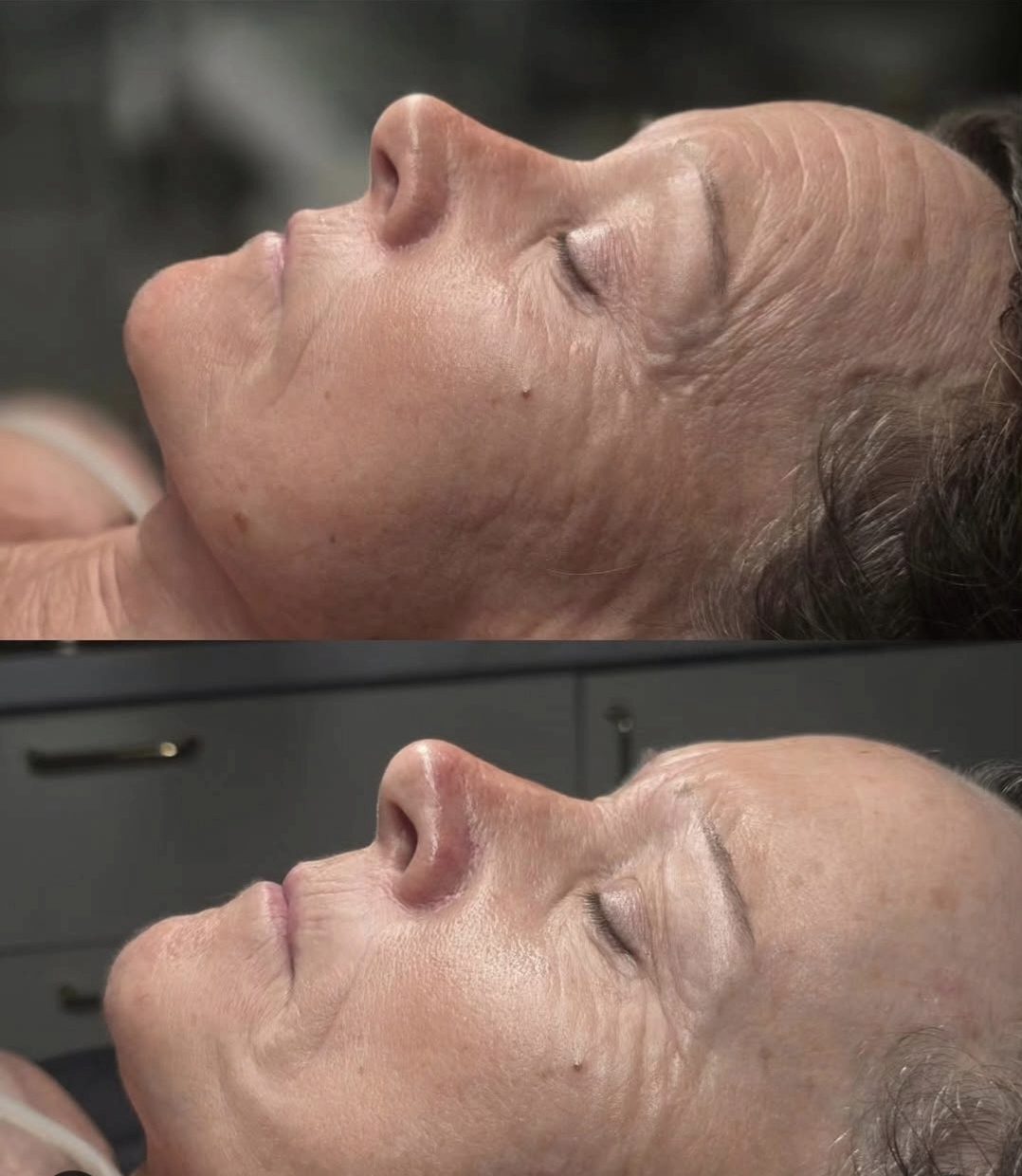 Before and after: smoother, brighter skin in profile