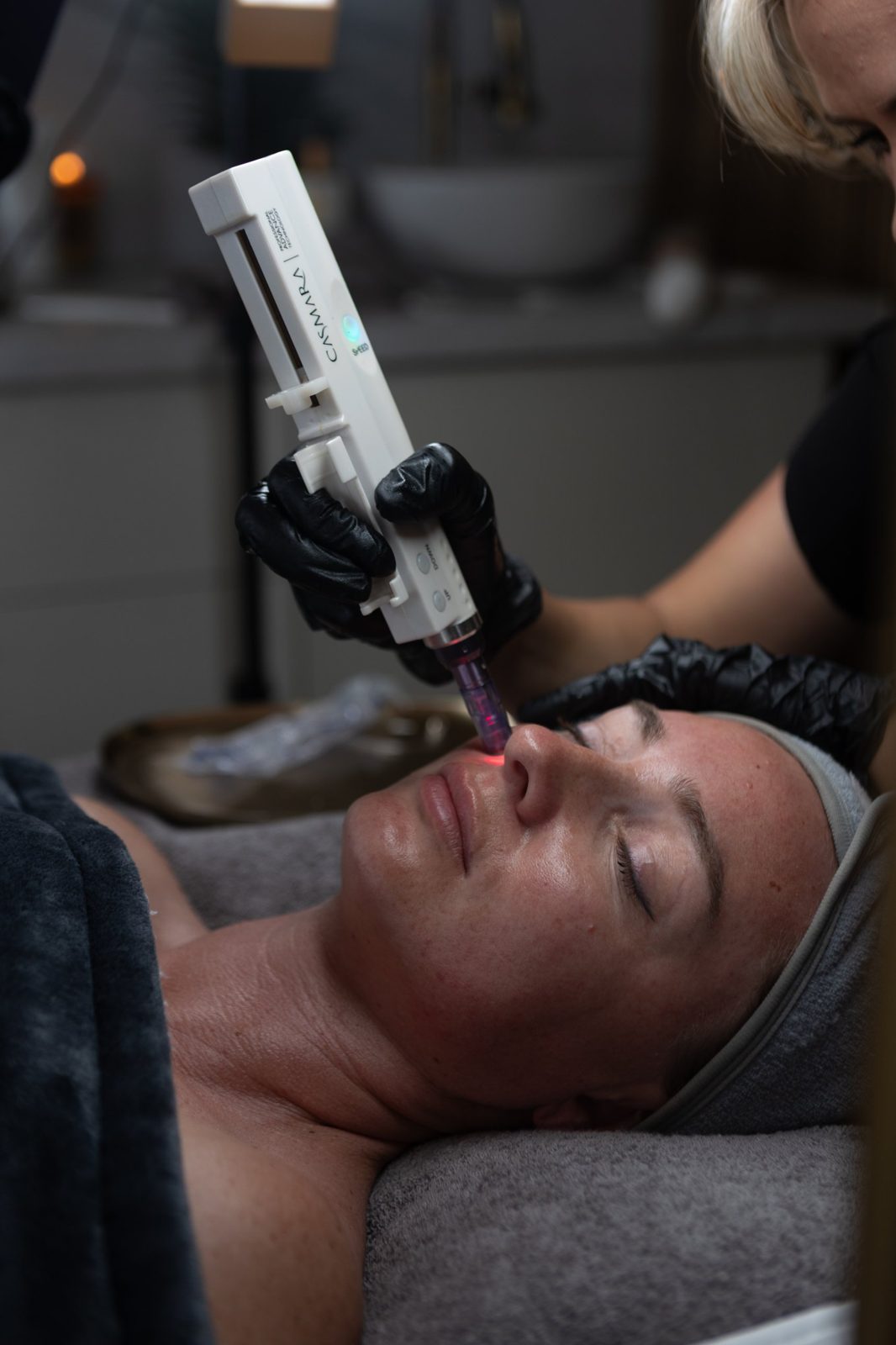 Casmara device treatment