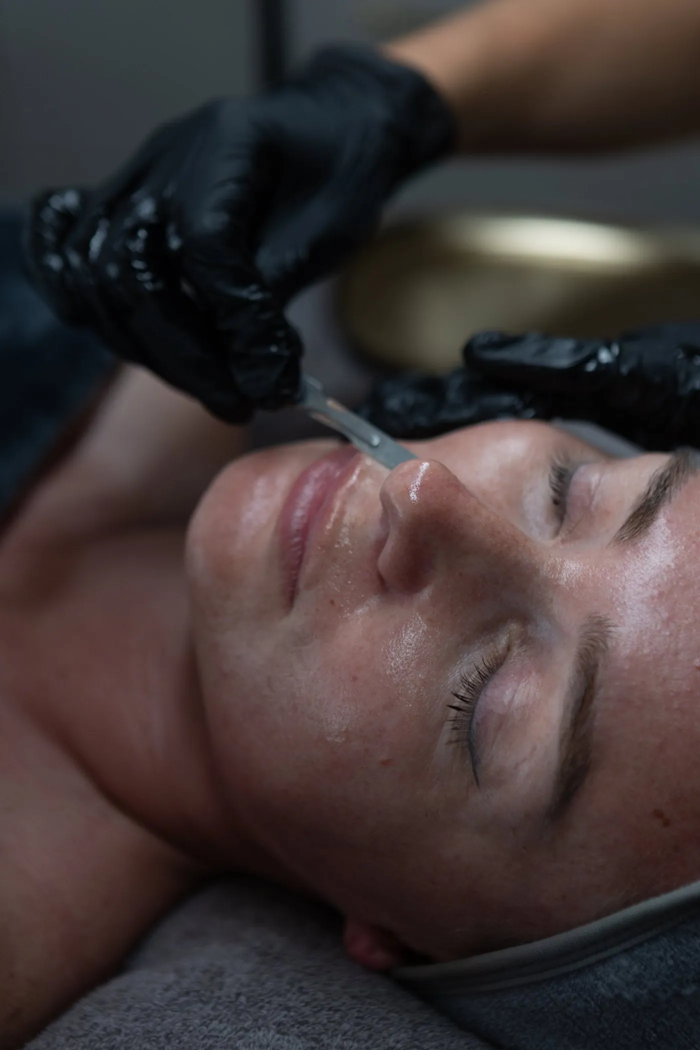 Dermaplaning treatment in progress