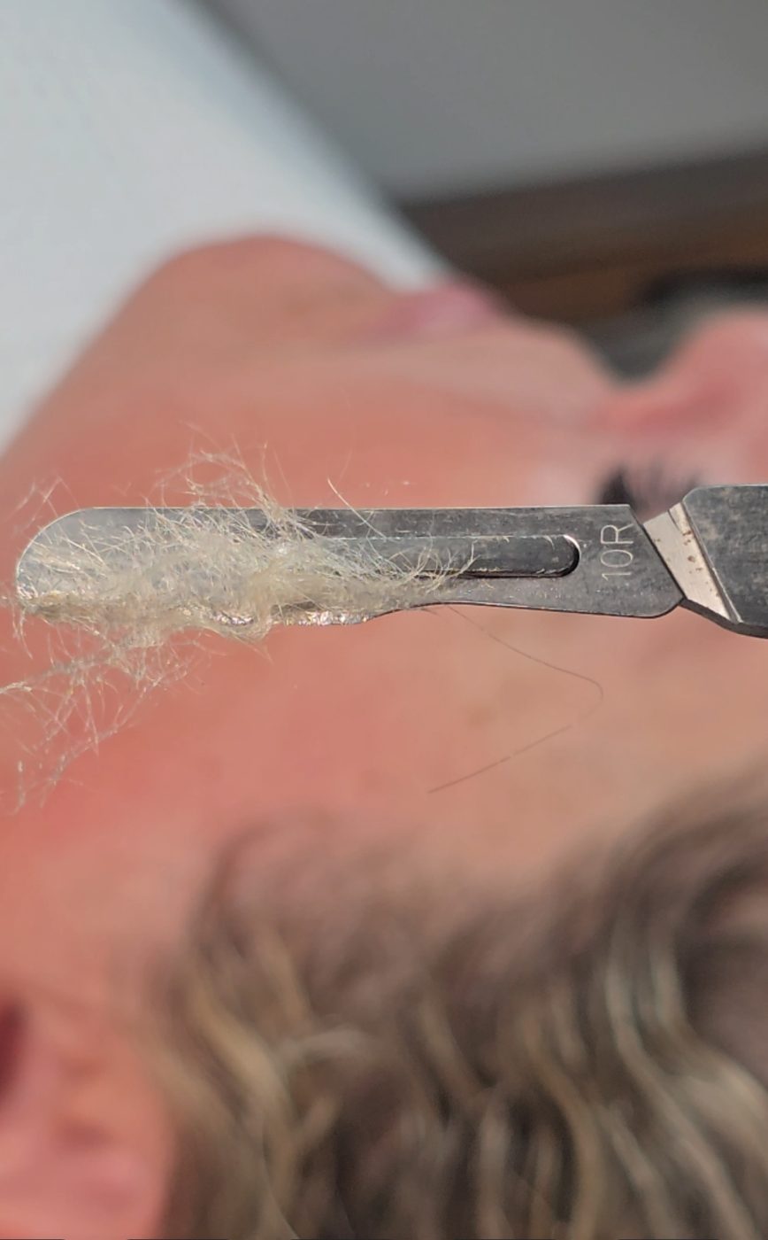 Dead skin and fine hair removed with dermaplaning