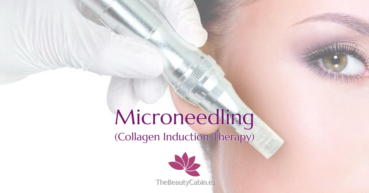 Microneedling (Collagen Induction Therapy) from the Beauty Cabin, Sitio de Calahonda, Mijas Costa