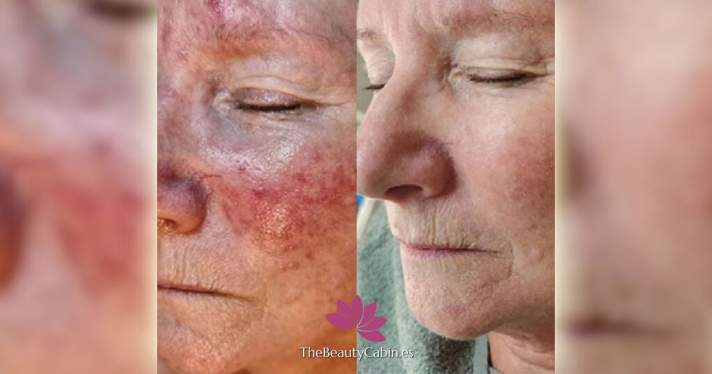 Rosacea Treatments