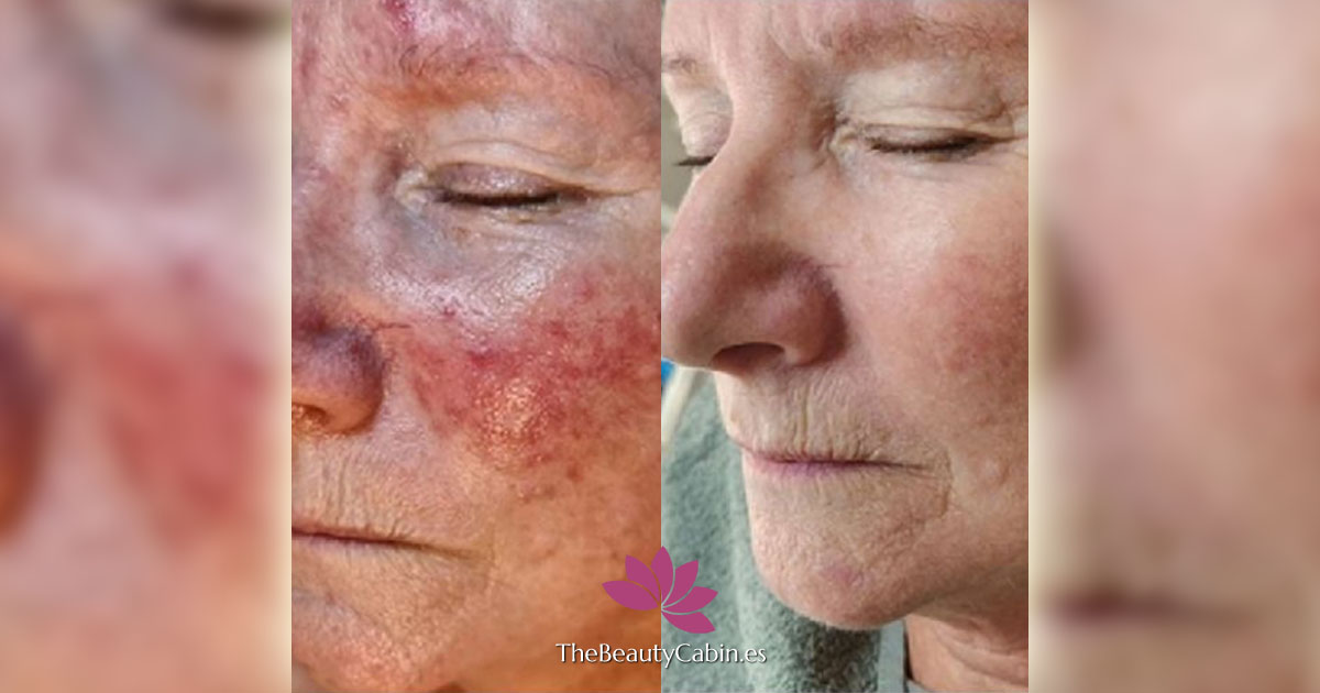 Rosacea Treatments